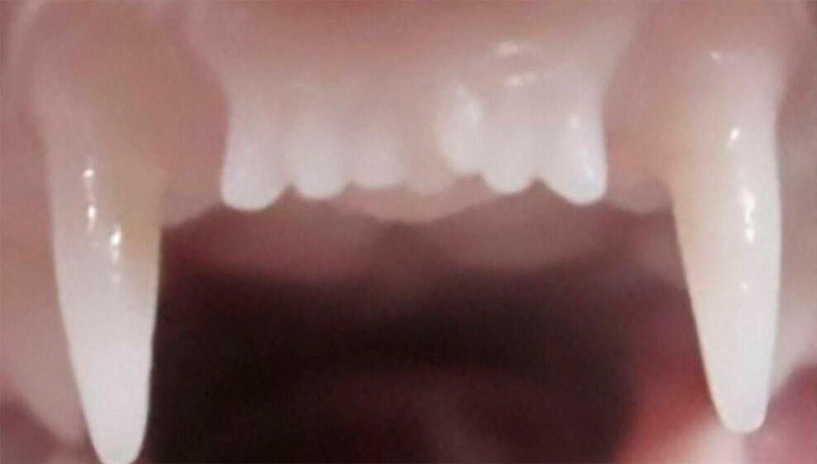 ¡Adiós a los implantes!